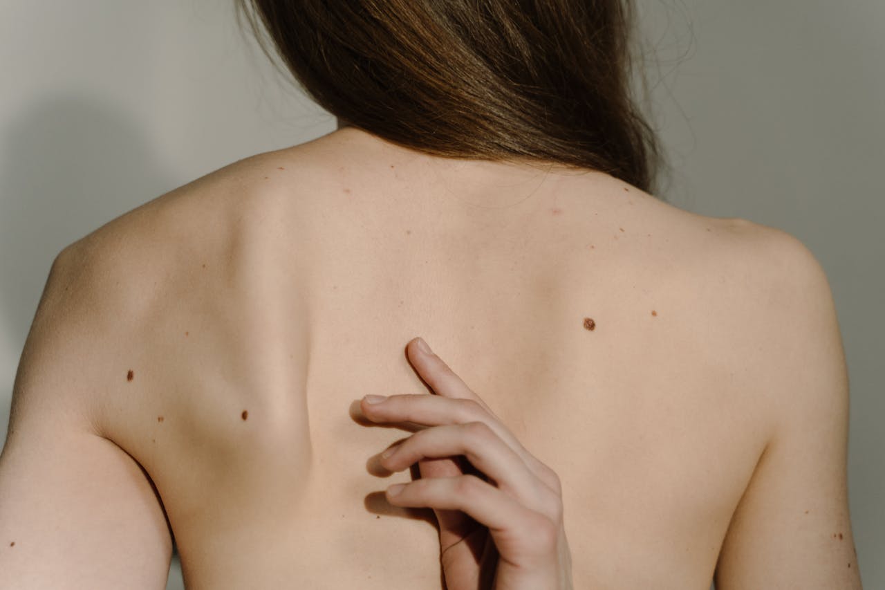A close-up shot of a bare back featuring prominent moles and a hand touching the skin.